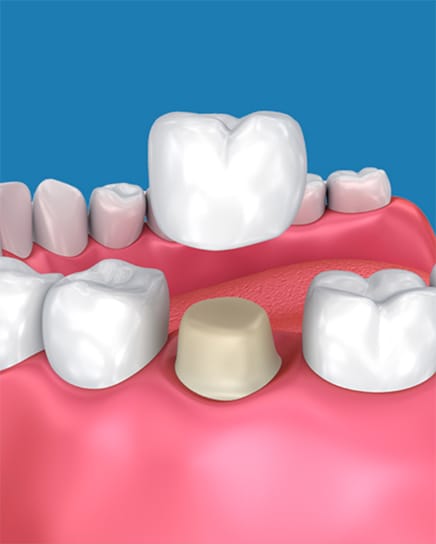 dental crown being placed on a graphic tooth