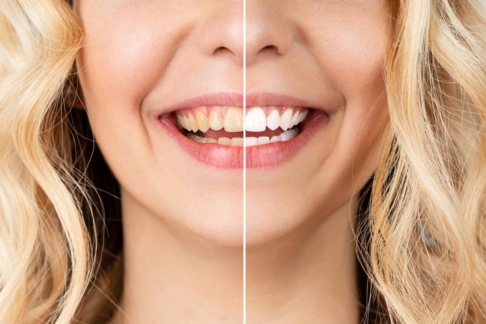 "Comparison of teeth color before and after whitening. The left image displays discolored teeth, and the right image showcases bright white teeth.